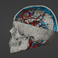 w3.png 3D Model of Brain Arteriovenous Malformation