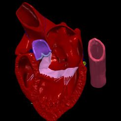 1.png Modèle 3D de cœur avec malformation septale auriculo-ventriculaire, vue des 4 cavités