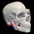 04.jpg 3D Model of Brain Arteriovenous Malformation