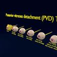posterior-vitreous-detachment-types-eye-3d-model-blend-88.jpg Posterior vitreous detachment types eye 3D model