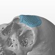 cranio-6.jpg A cranial plate to replace a skull defect (an example of a real operation 2)