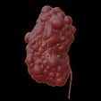 10.jpg 3D Model of Polycystic Kidney