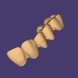 Clipboard-2024-12-21-00-27-53.jpg DIGITAL FLEXIBLE UPPER PARTIAL DENTURE  (3D models !!!) - 7 stl files for download)