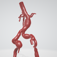 p2.png Case 1 to 6: 3D aortic and iliac artery aneurysm