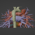4.png 3D Model of Human Heart with Pulmonary Artery Sling (PAS) - generated from real patient