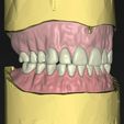 uplow.jpg Digital total dentures
