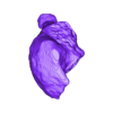 STL00004.stl 3D Model of Human Heart with Common Arterial Trunk (CAT) - generated from real patient