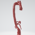 p4.png Case 1 to 6: 3D aortic and iliac artery aneurysm